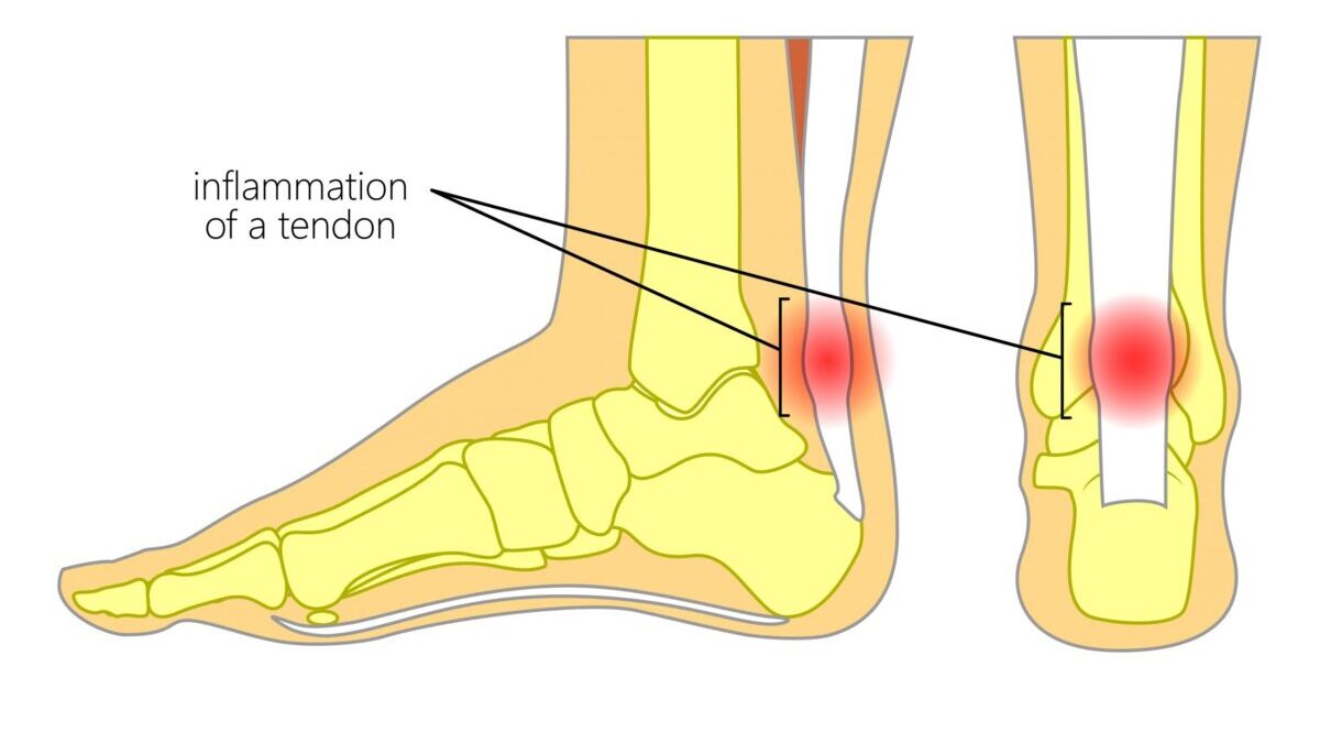 Achilles Tendonitis