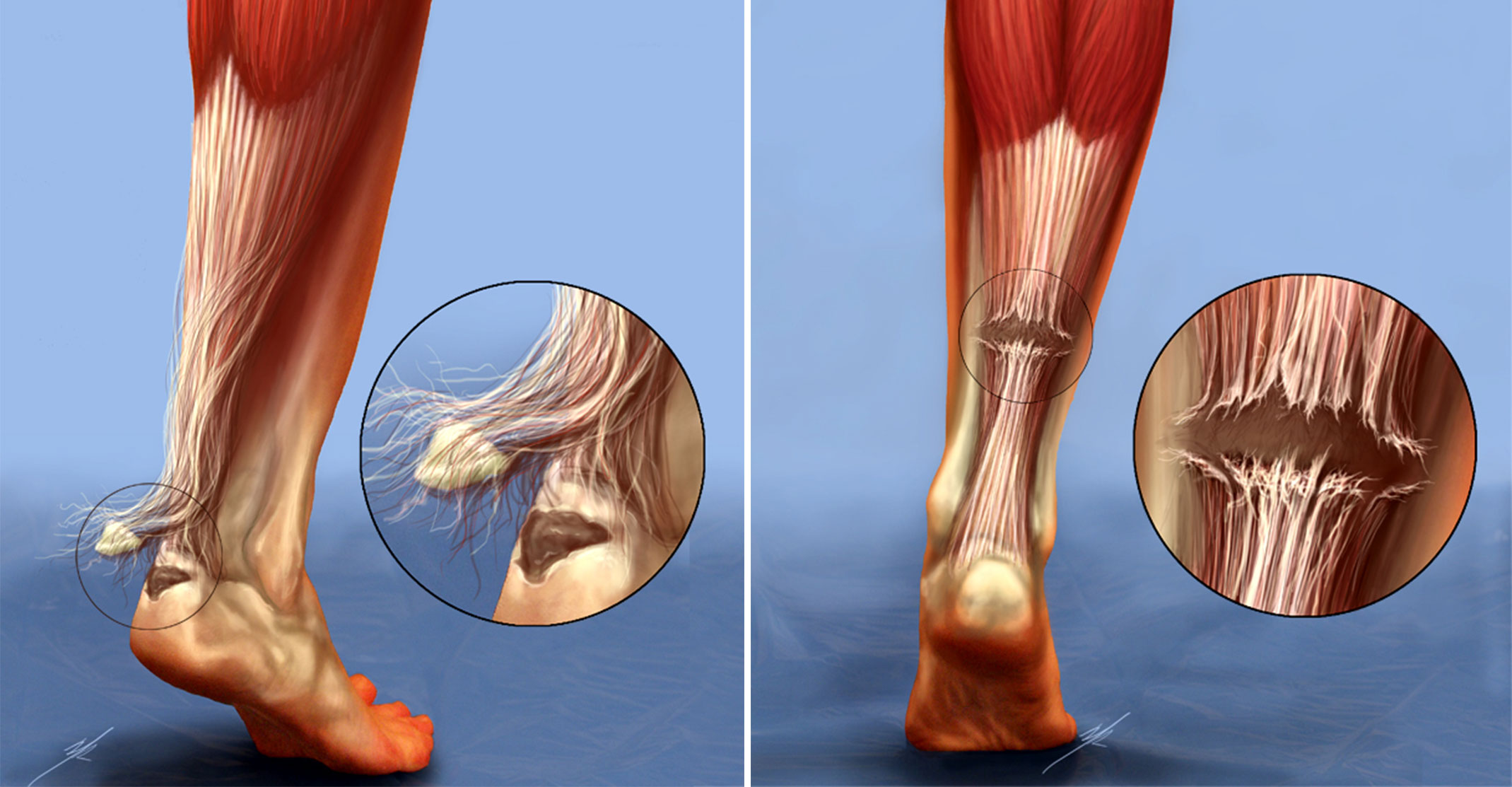 Signs and Symptoms of Achilles Injury