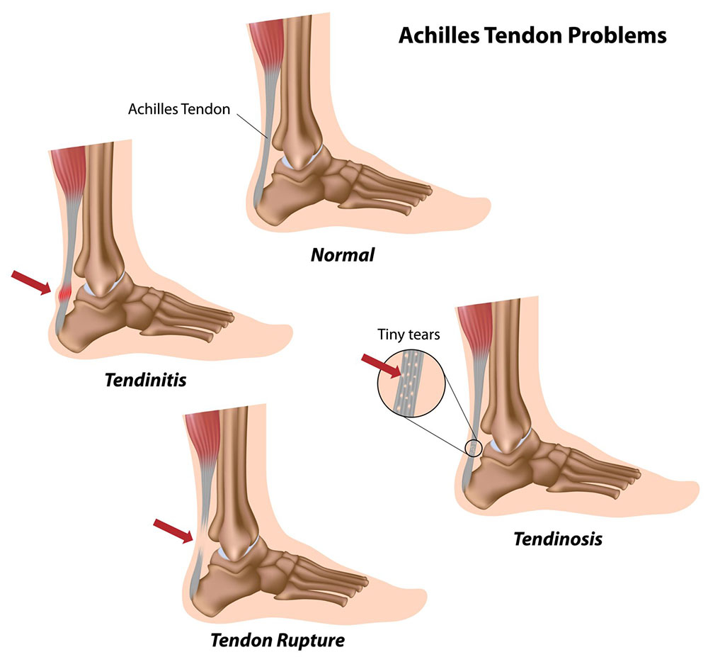 What Is Achilles Tendonitis