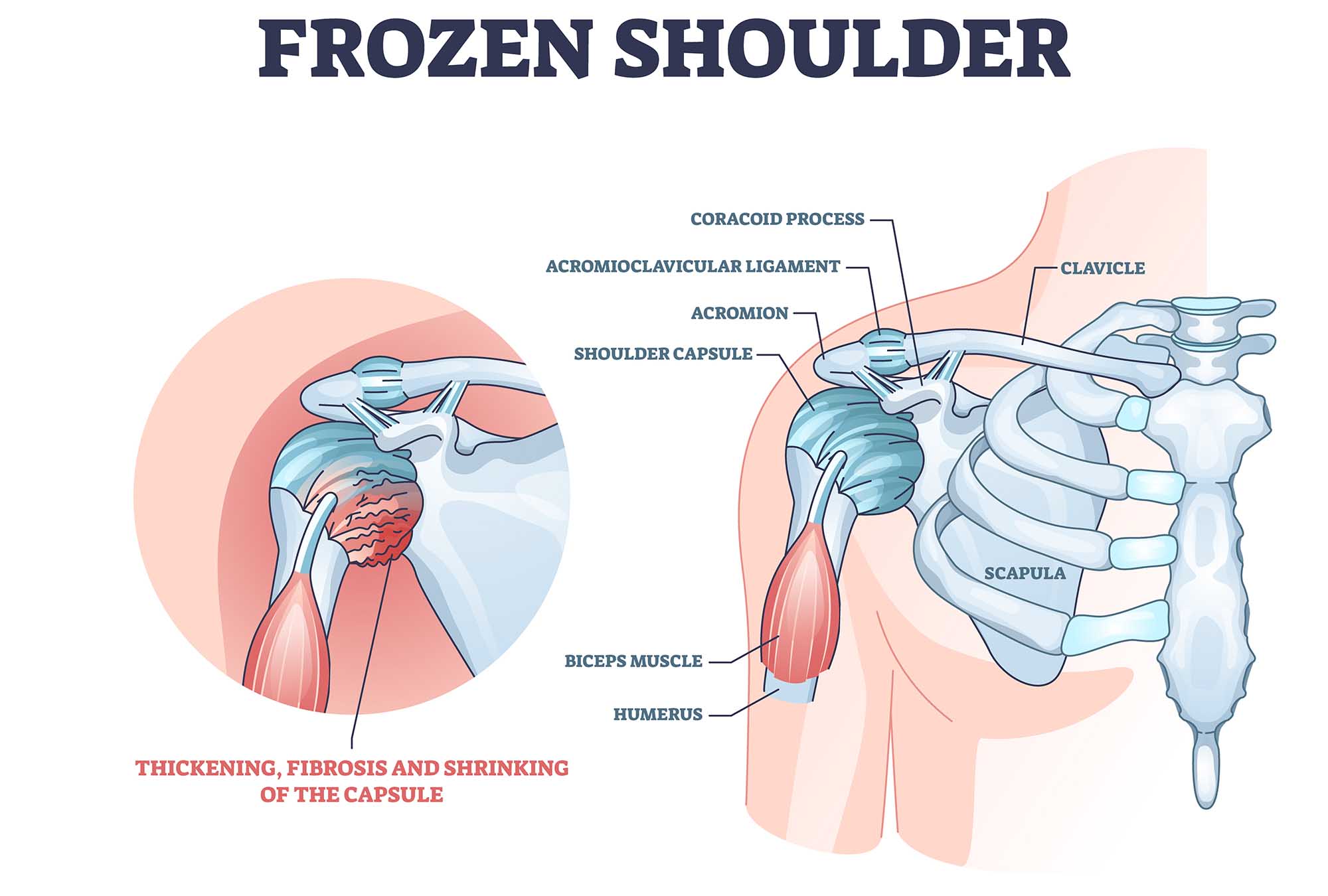 Causes of Frozen Shoulder