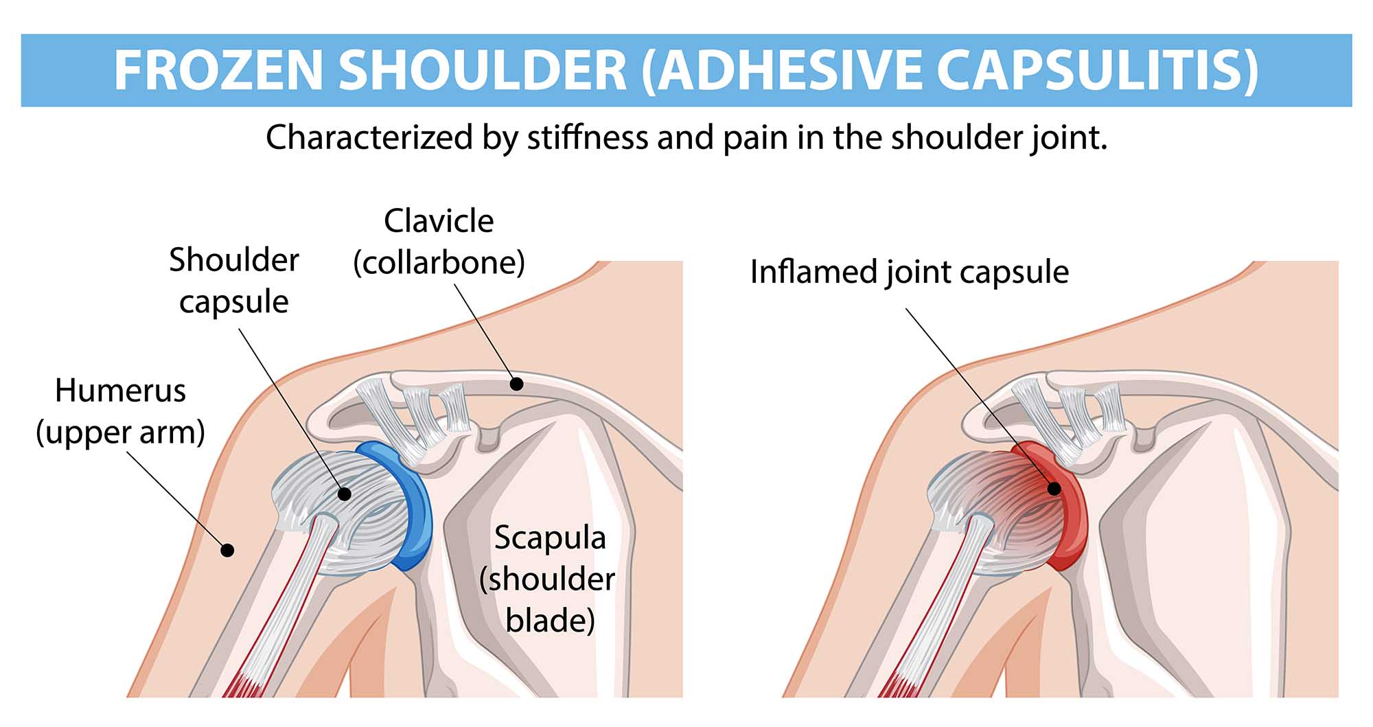 What is Frozen Shoulder? (Adhesive Capsulitis)
