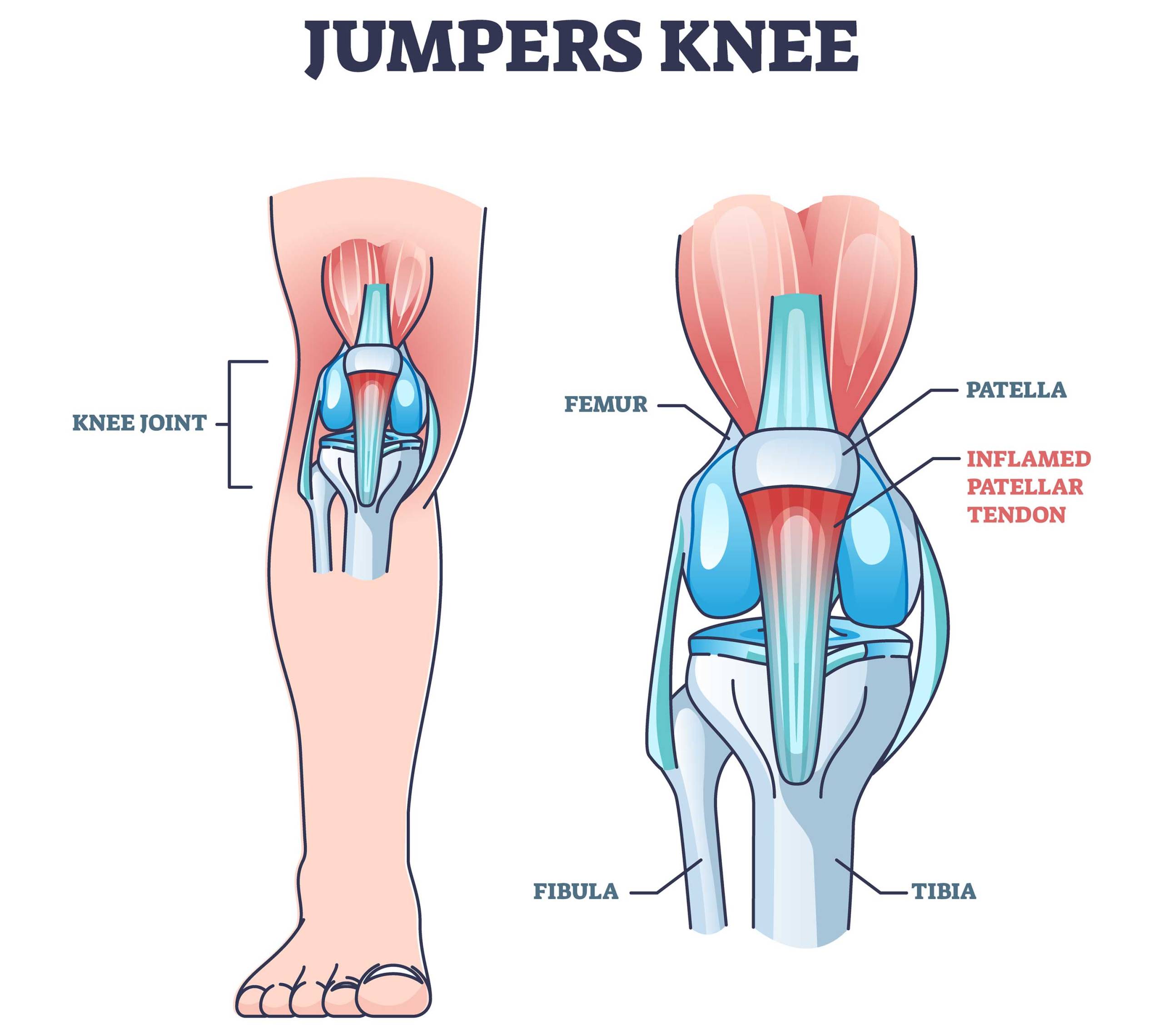 Common Symptoms of Jumper’s Knee